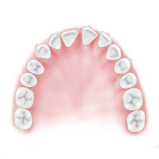 ↪ Folgetemplate: Invisalign Schienen eingesetzt